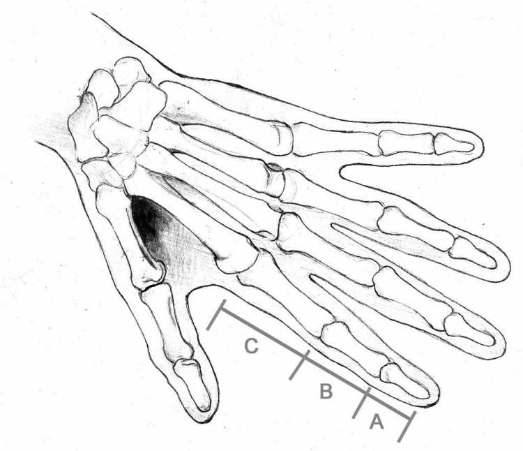 Сесамовидные кости кисти